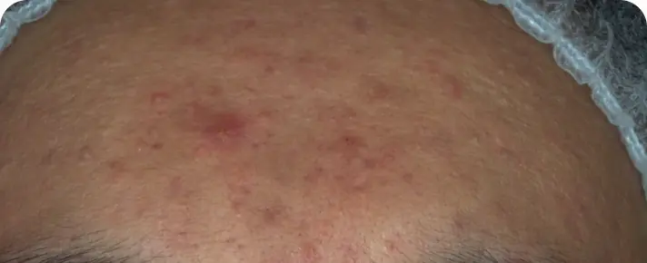 Hasil perawatan jerawat klien 02 sebelum