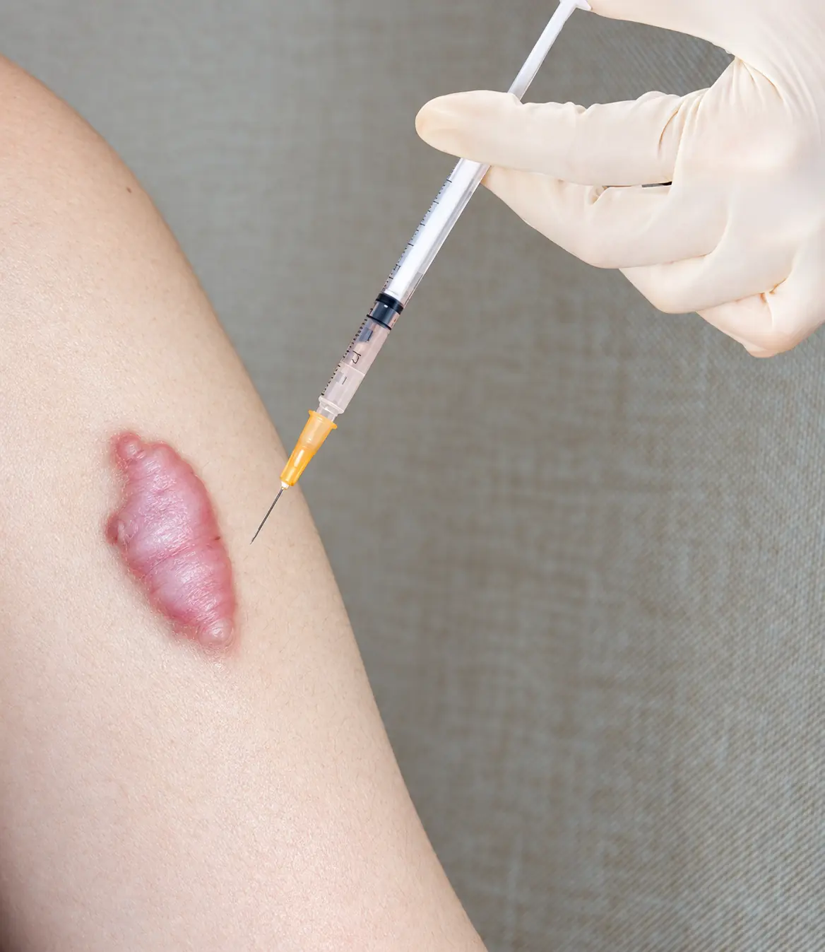 Perawatan keloid dan bekas luka