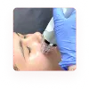 Laser Resurfacing