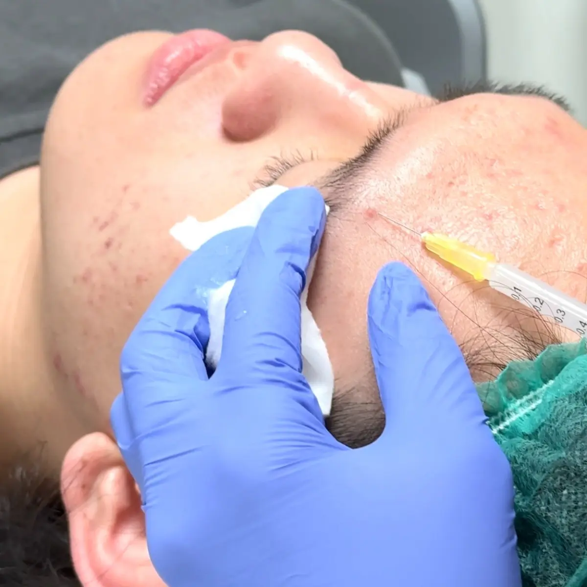 Acne Rescue Injection