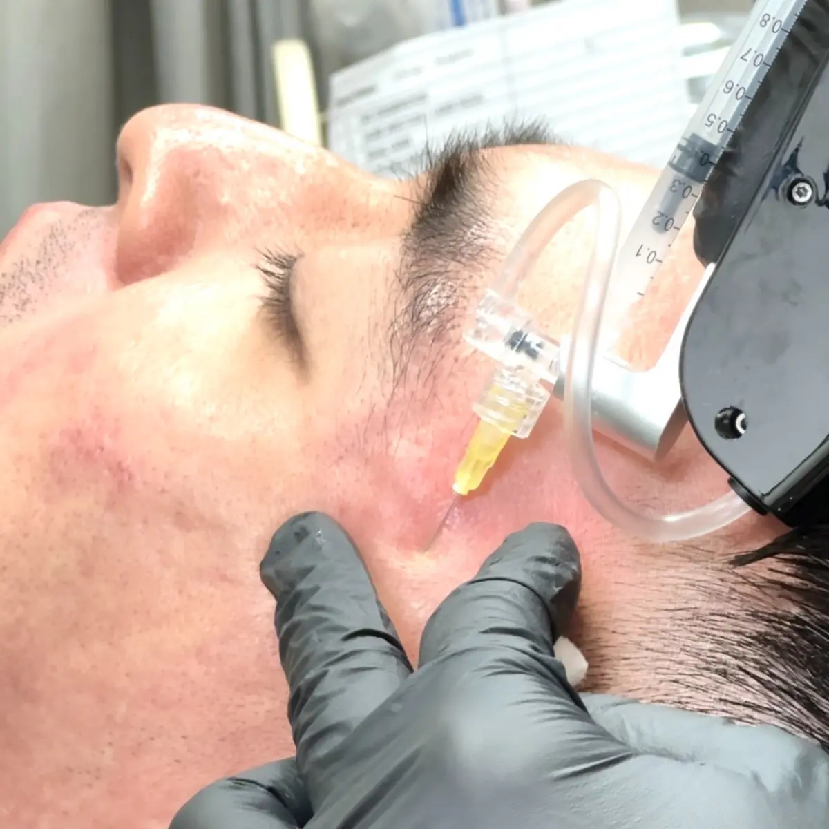Air-lift Collagen Biostimulator Scar Correction