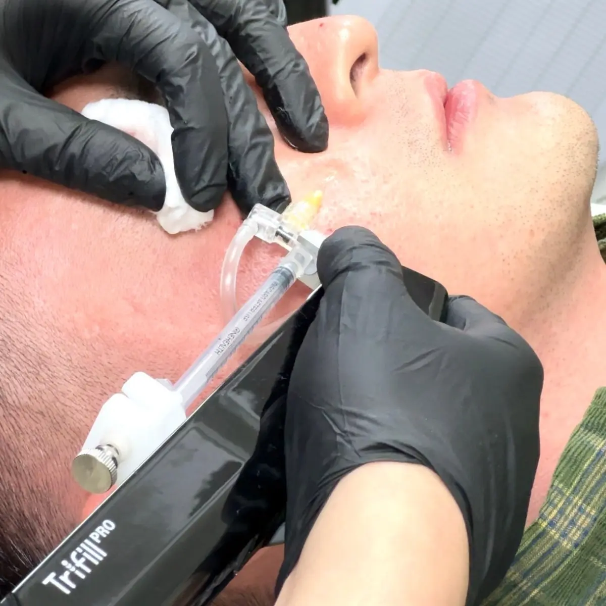 CO2 Scar Lift