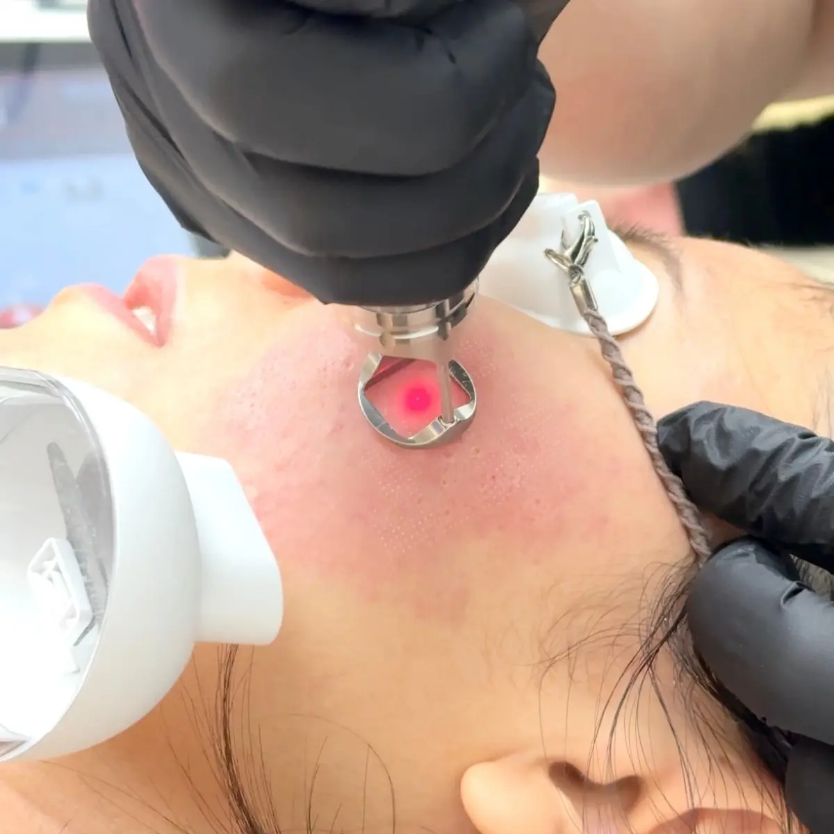 Laser Facial Acne