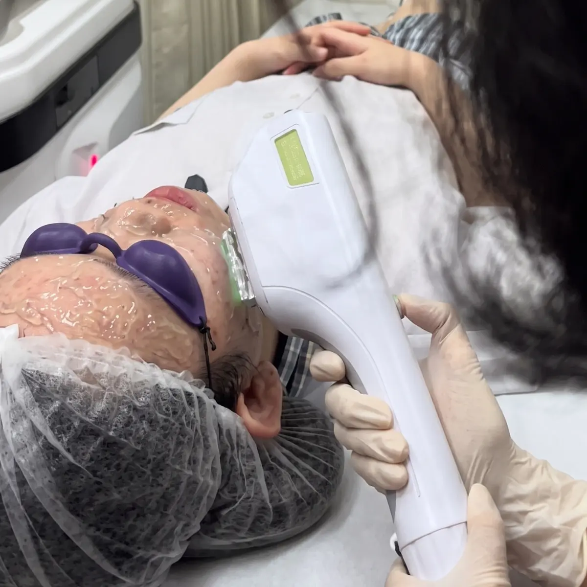 Acne-Clear Photofacial