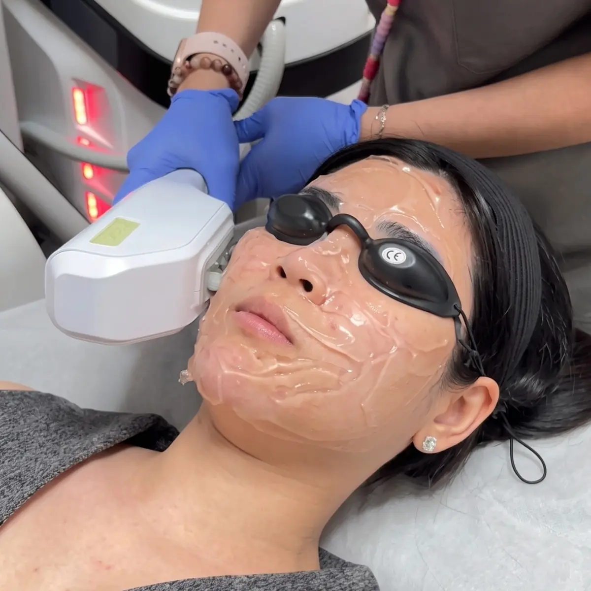 Radiance Photofacial