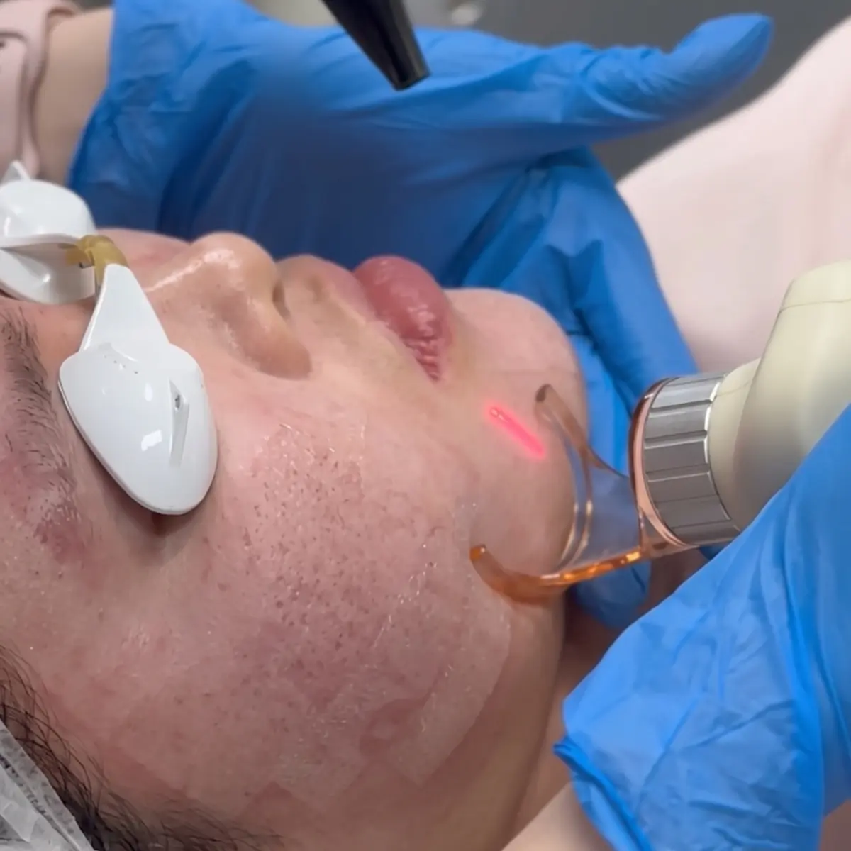 Deep Laser Resurfacing