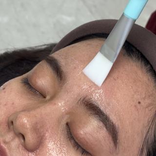 Acne Clear Peel