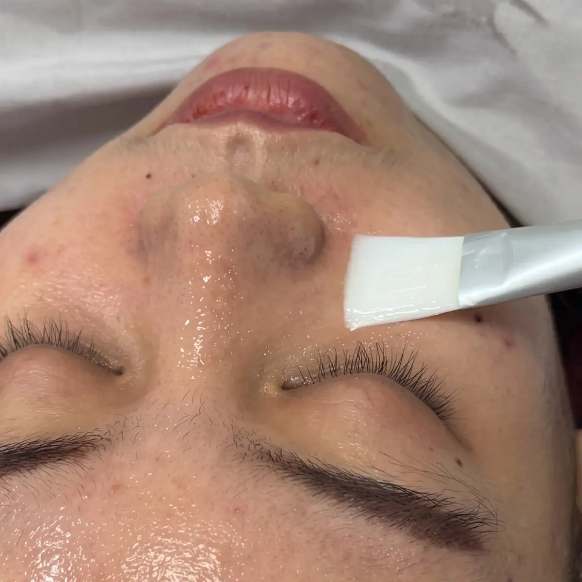 Gentle Acne Peel