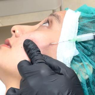 Acne Scar Subcision