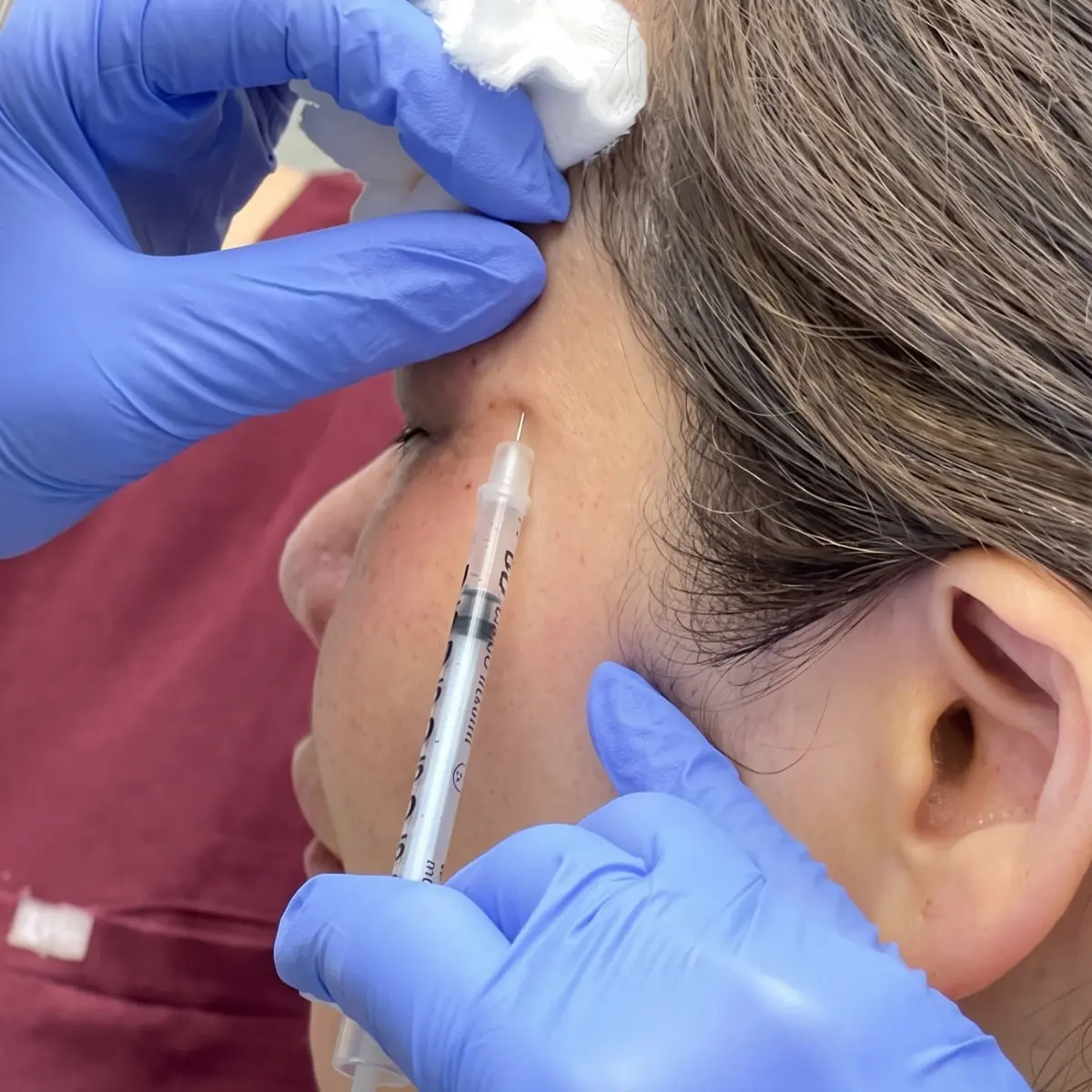 Wrinkle Relax Injection Botox