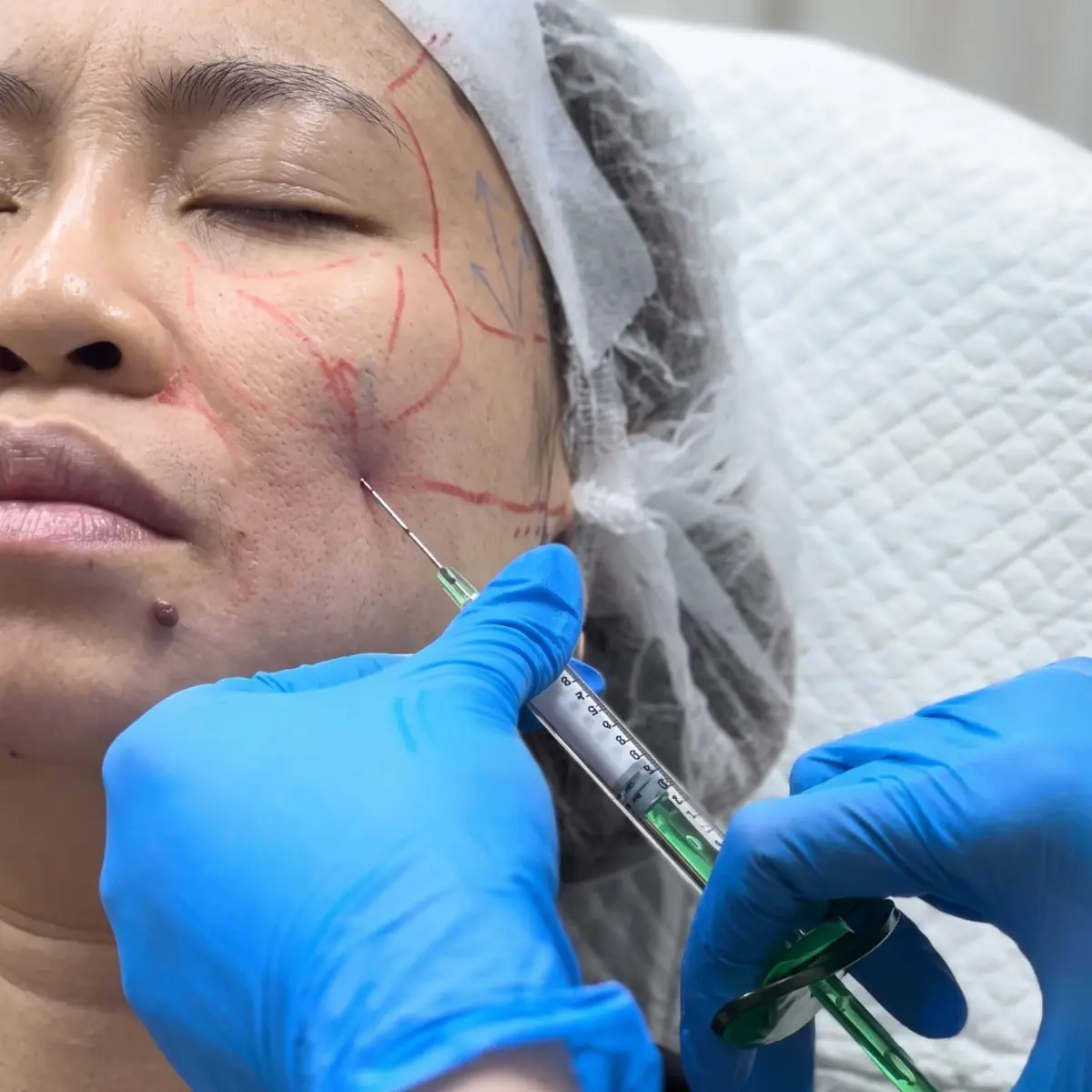 Collagen Stimulator For Scar Correction