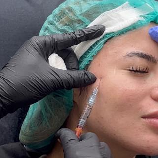 Acne Scar Filler