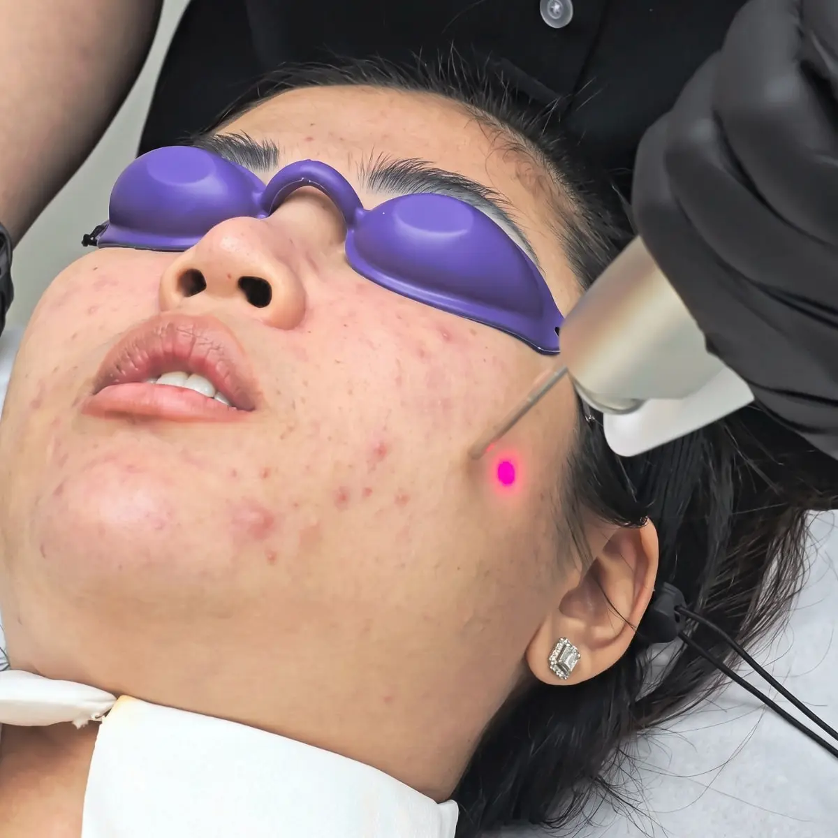 Acne Vascular Laser