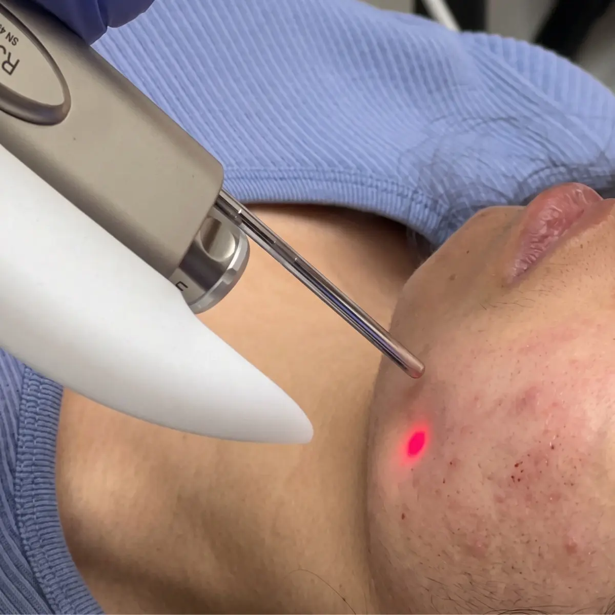 Redness Calm Laser