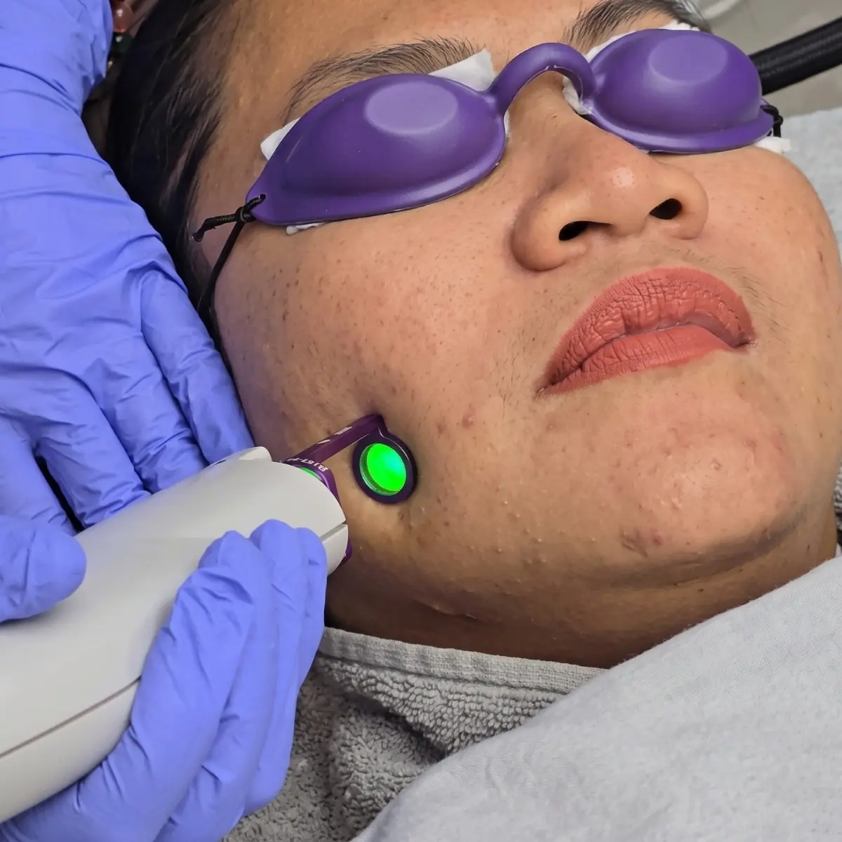 Vascular Laser 